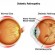 Myopia progression slows by contact lenses